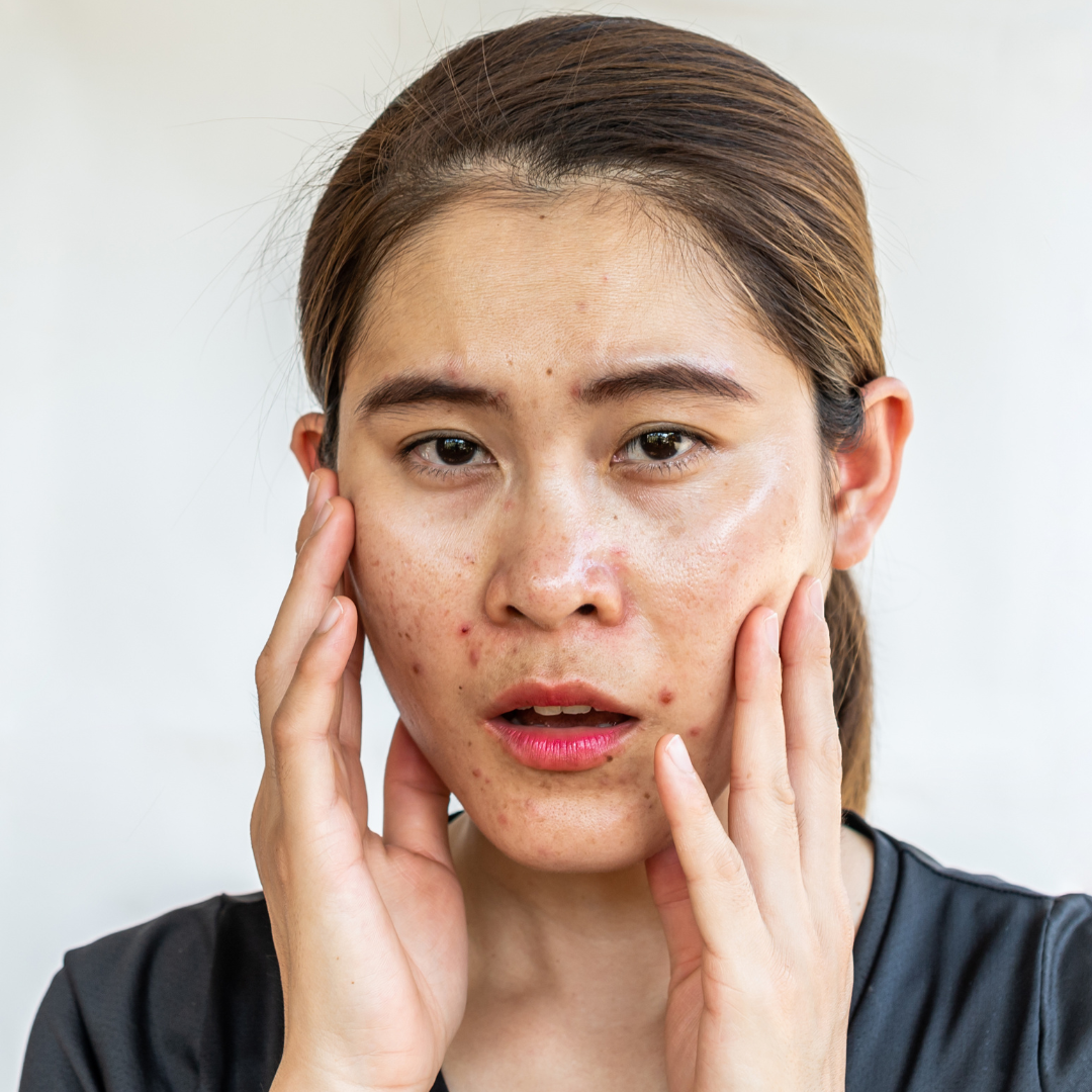 anti-bacterial acne serum