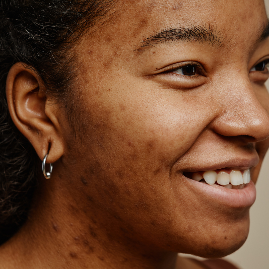 Do Acne Scars Go Away Naturally?