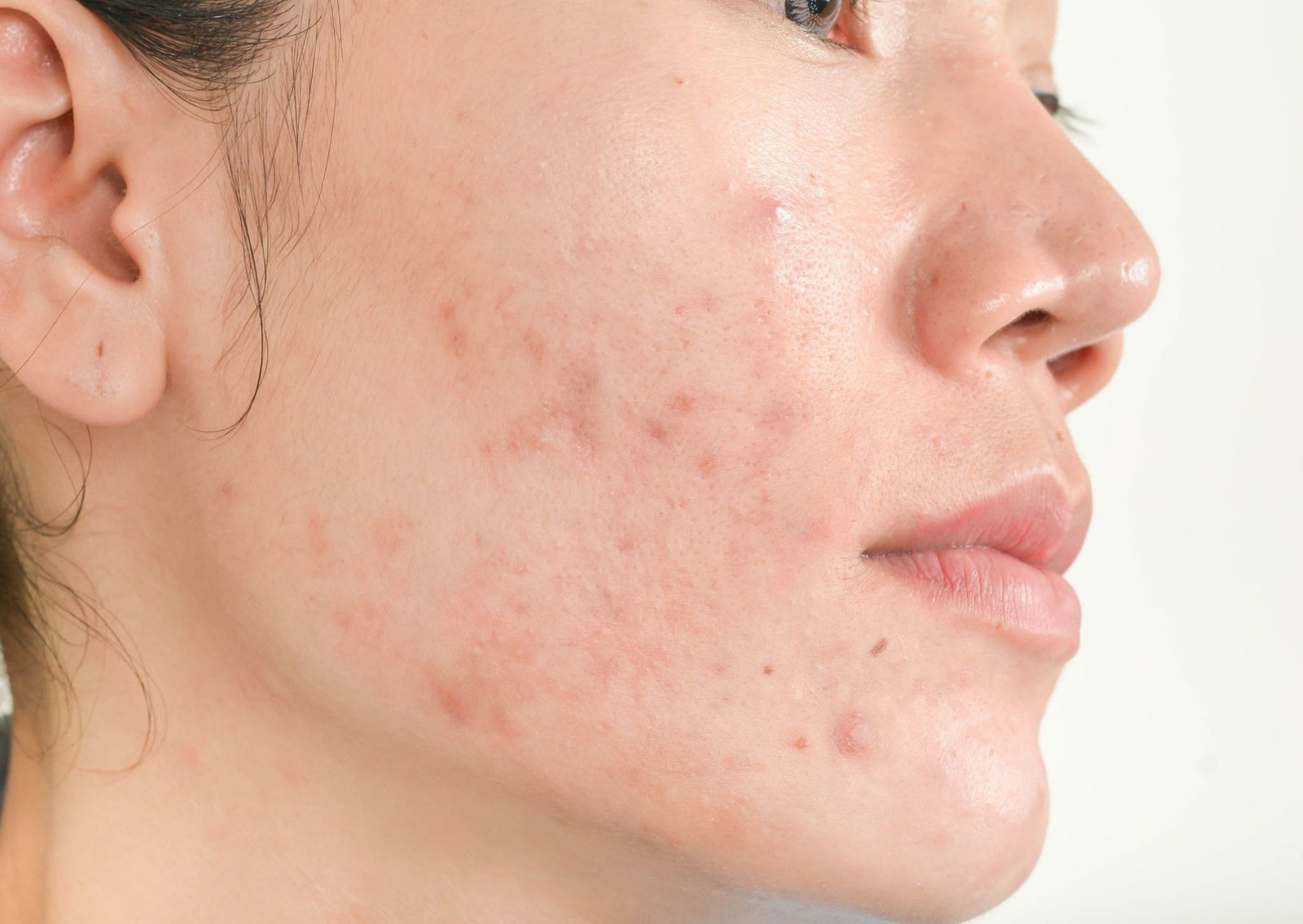 Still Getting Acne in Our 30s? Read this! | Millionaire Beauty