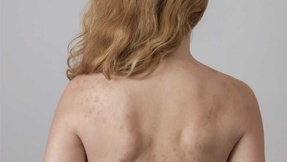 5 Top Tips on How To Get Rid Of Backne – AKA Back Acne - Millionaire Beauty
