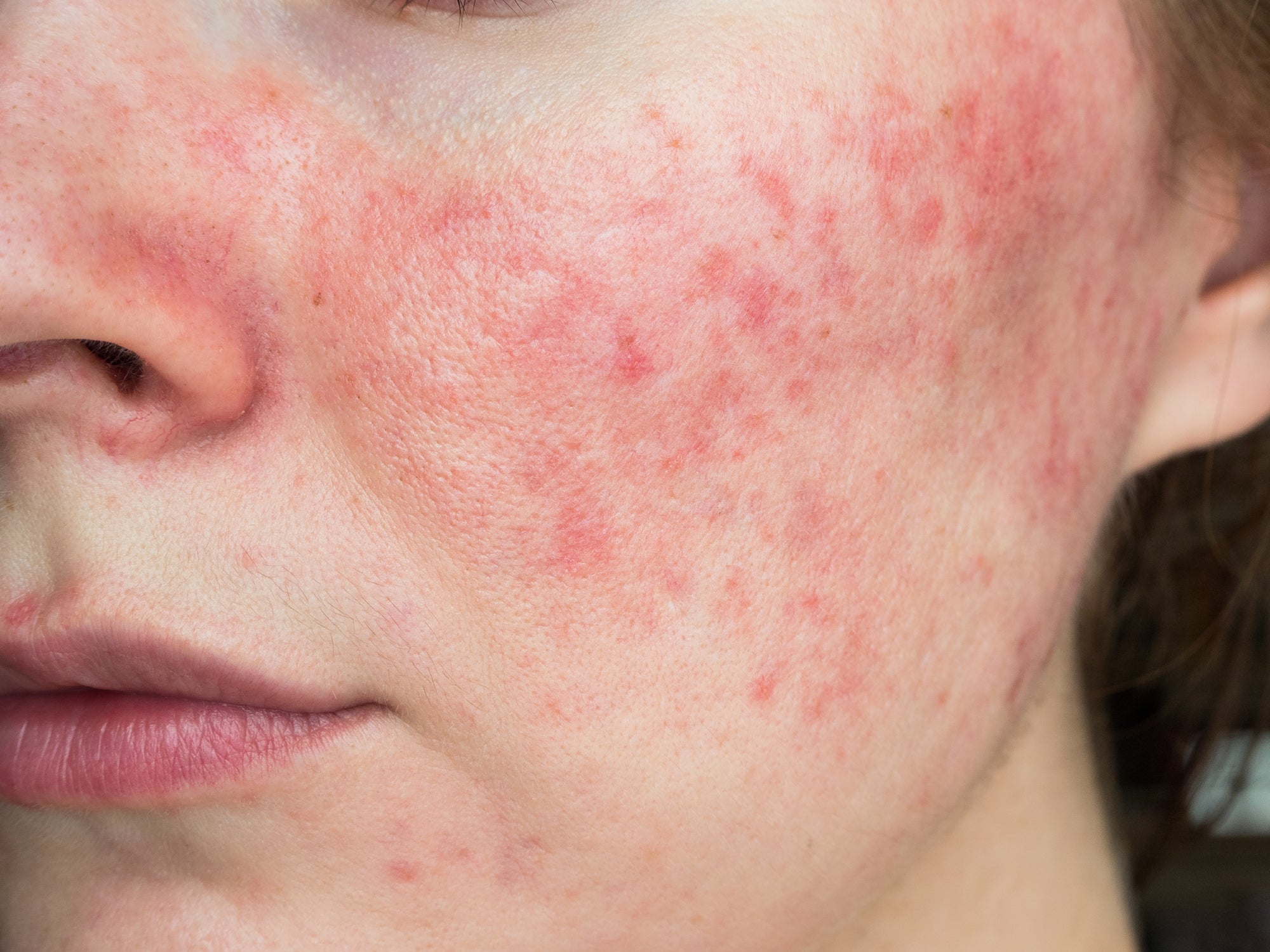 What Causes Acne Scars?