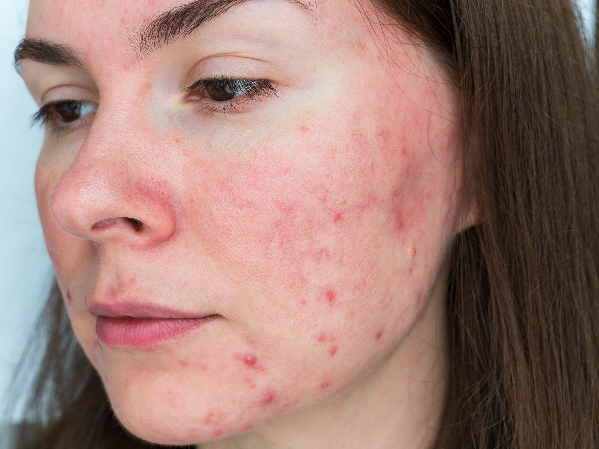 Are Chemical Exfoliations Good For Acne?