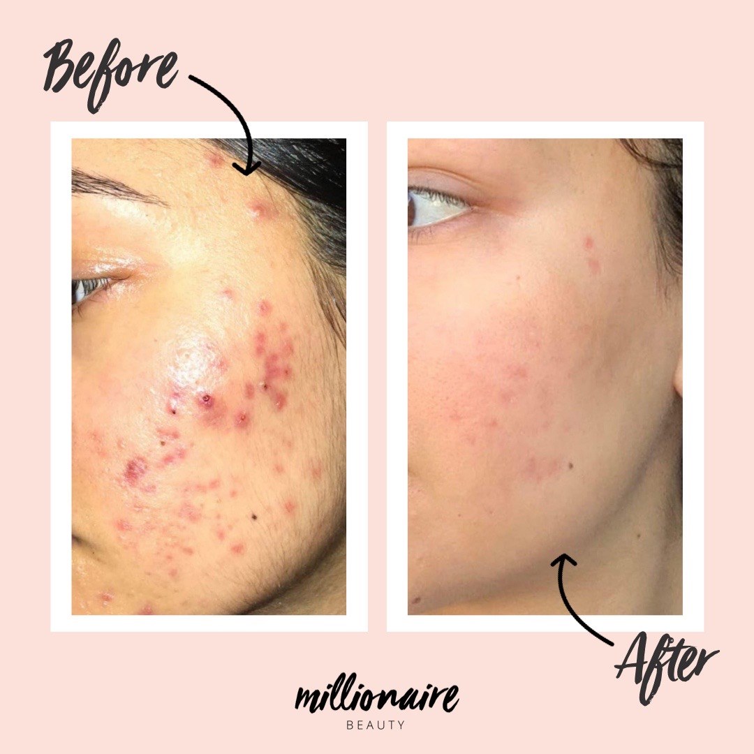 Before & After Acne Breakout Skincare Routine