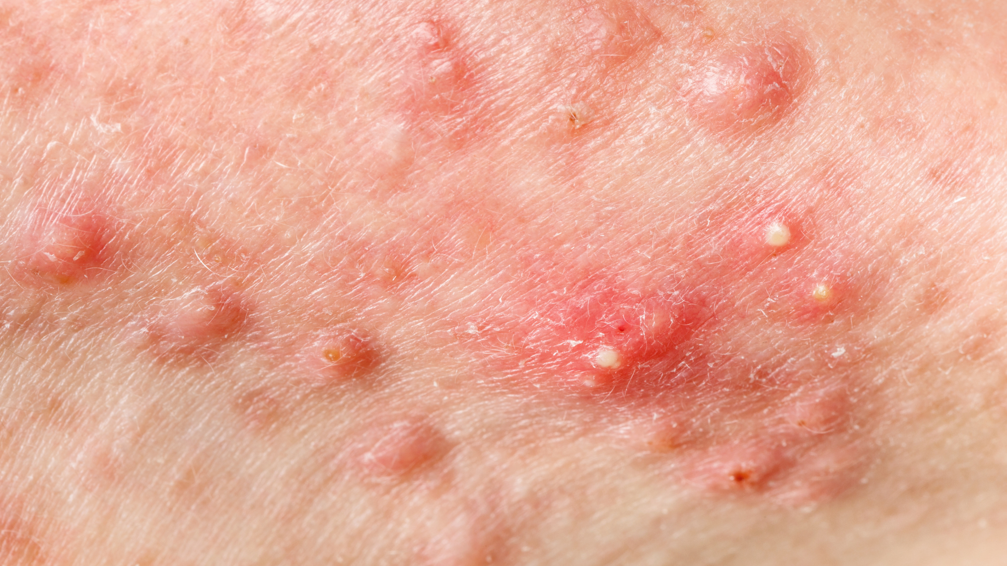 Is Adult Acne Common?