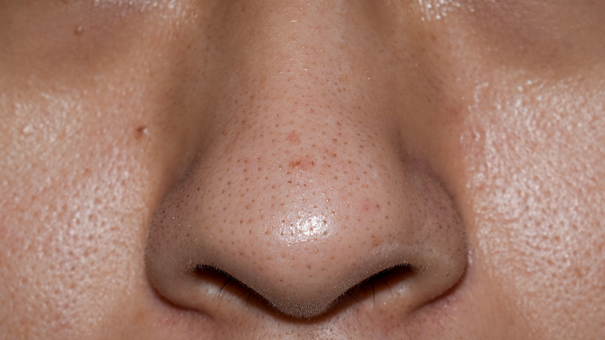 Pore Perfection: Your Guide to Getting Rid of Blackheads