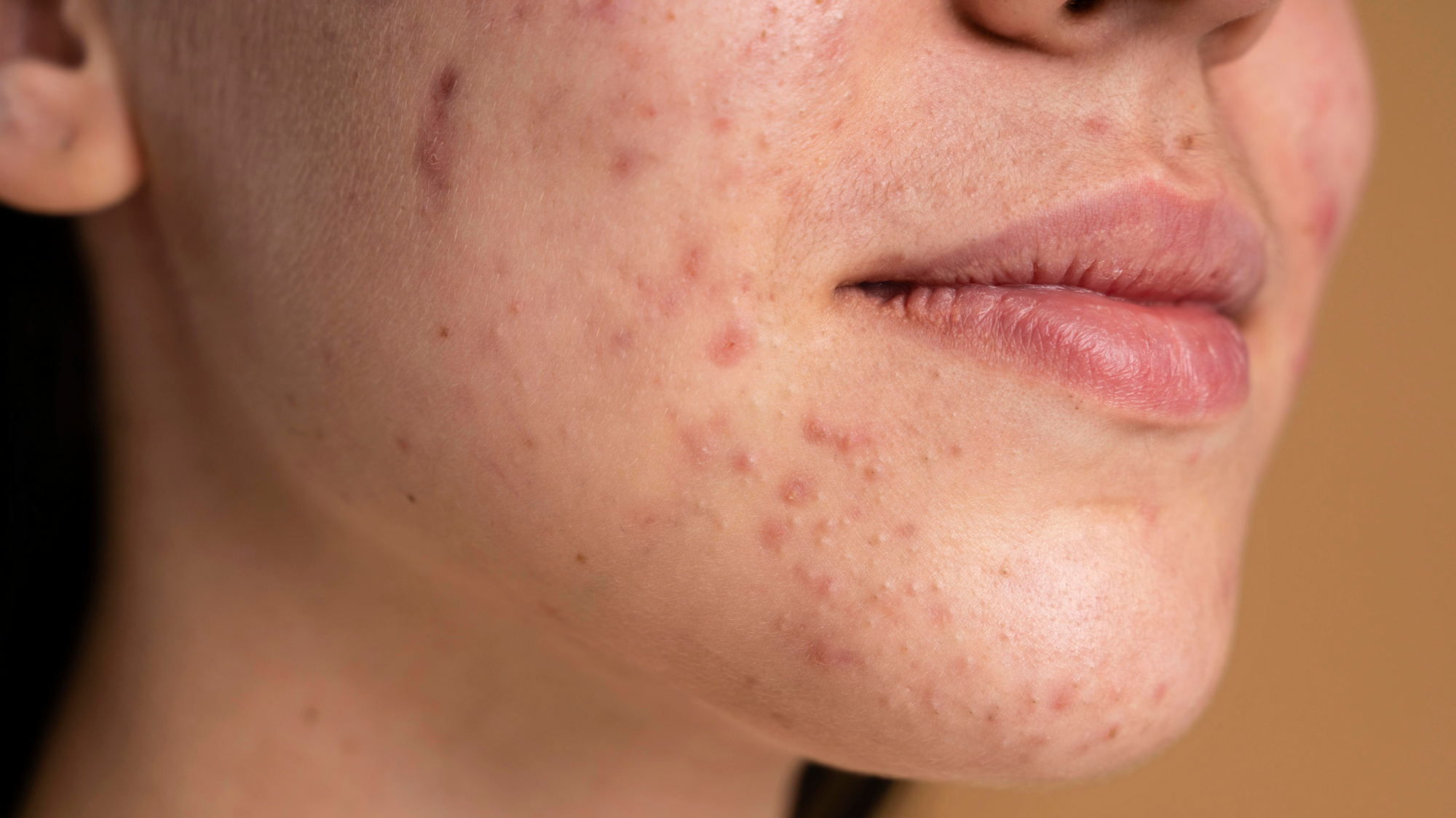 Should You Exfoliate If You Have Hormonal Acne?