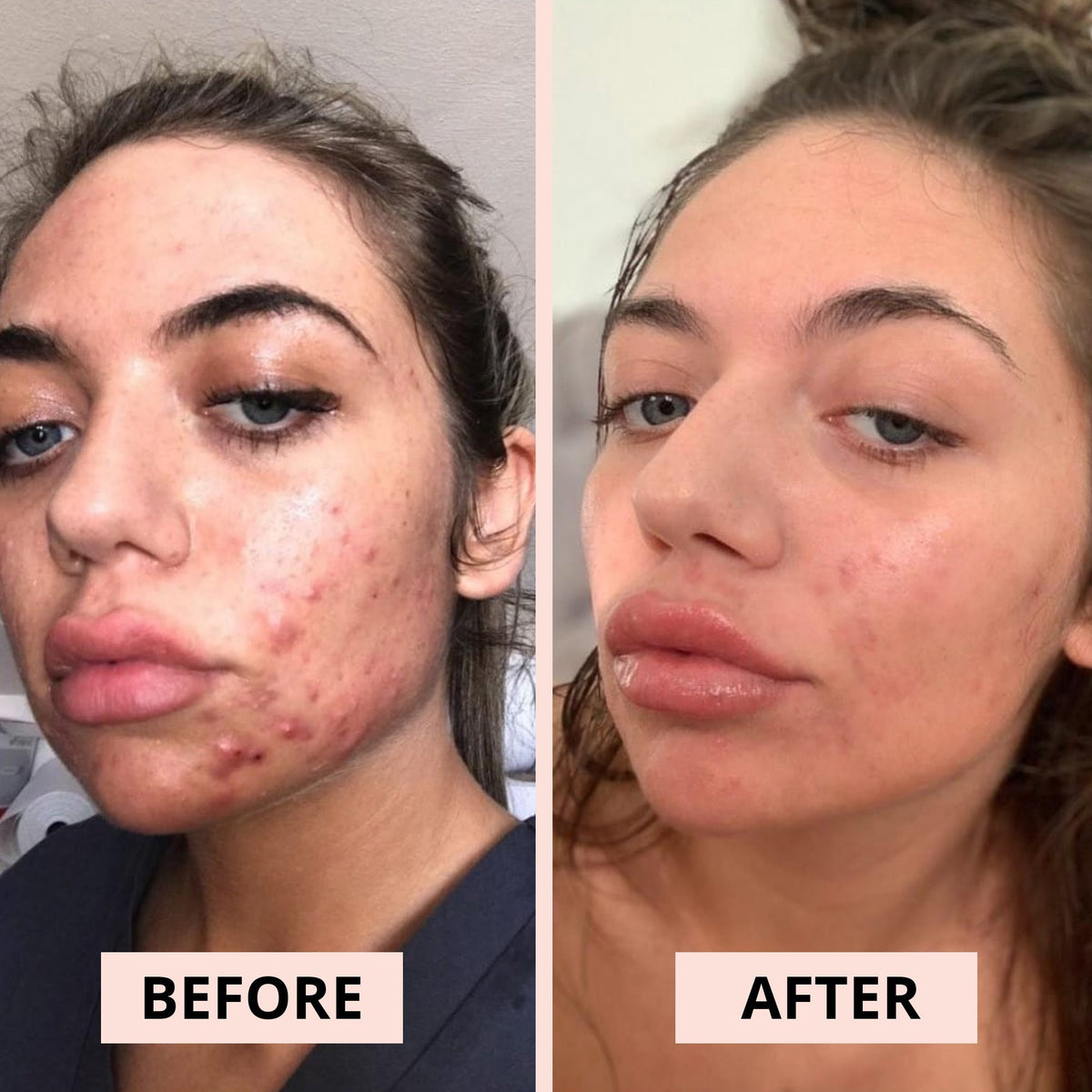 Which products are best for acne? Millionaire Beauty